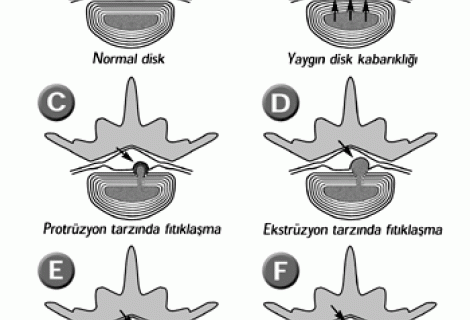 Bel Fıtığı Belirtileri